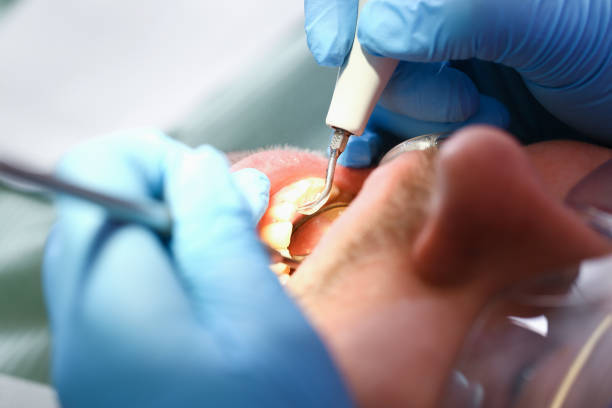 Best Emergency Wisdom Teeth Removal in Kearny, NJ
